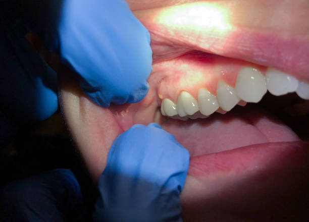 Best Dentist for Tooth Abscess  in Andrews, IN